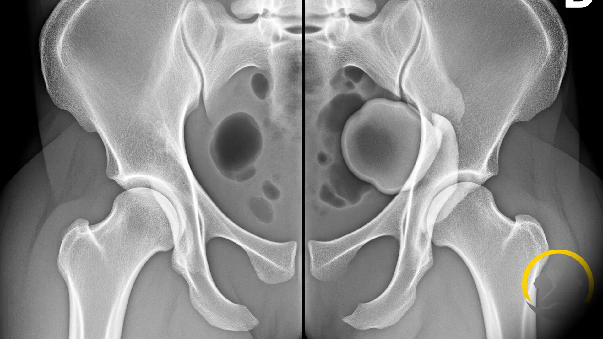 تشخیص دیسپلازی مفصل ران در سگ با استفاده از عکس رادیولوژی (X-ray).